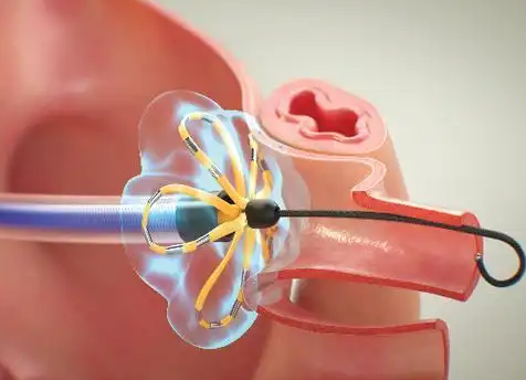 以色列伯恩森斯韋伯斯特Biosense Webster一次性使用磁定位心臟脈沖電場消融導(dǎo)管D141201IL
